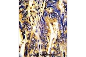 Formalin-fixed and paraffin-embedded human colon carcinoma with AXL Antibody, which was peroxidase-conjugated to the secondary antibody, followed by DAB staining. (AXL antibody)