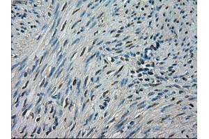 Immunohistochemical staining of paraffin-embedded endometrium tissue using anti-CRYABmouse monoclonal antibody. (CRYAB antibody)