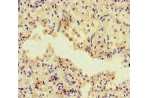 Immunohistochemistry of paraffin-embedded human lung cancer using ABIN7143320 at dilution of 1:100