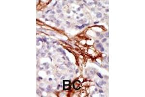 Formalin-fixed and paraffin-embedded human cancer tissue reacted with the primary antibody, which was peroxidase-conjugated to the secondary antibody, followed by AEC staining.