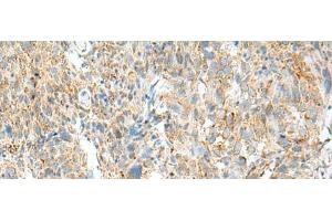 Immunohistochemistry of paraffin-embedded Human cervical cancer tissue using MCCC1 Polyclonal Antibody at dilution of 1:45(x200) (MCCC1 antibody)