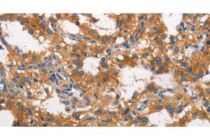 Immunohistochemistry of paraffin-embedded Human thyroid cancer using CLTC Polyclonal Antibody at dilution of 1:60 (Clathrin Heavy Chain (CLTC) antibody)