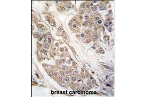 Formalin-fixed and paraffin-embedded human breast carcinoma tissue reacted with CTDSP2 Antibody (N-term) (ABIN392885 and ABIN2837997) , which was peroxidase-conjugated to the secondary antibody, followed by DAB staining. (CTDSP2 antibody  (N-Term))