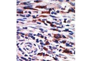 Formalin-fixed and paraffin-embedded human cancer tissue reacted with the primary antibody, which was peroxidase-conjugated to the secondary antibody, followed by AEC staining. (PKC eta antibody  (N-Term))