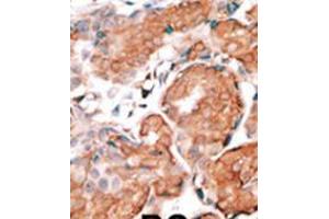 Formalin-fixed and paraffin-embedded human cancer tissue reacted with the primary antibody, which was peroxidase-conjugated to the secondary antibody, followed by DAB staining. (GCAP1 antibody  (C-Term))