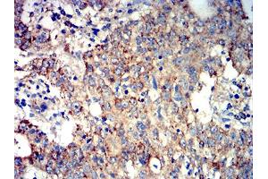 Immunohistochemical analysis of paraffin-embedded stomach cancer tissues using ATG3 mouse mAb with DAB staining. (ATG3 antibody  (AA 1-100))