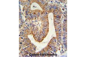 RPL17 Antibody (C-term) IHC analysis in formalin fixed and paraffin embedded colon carcinoma followed by peroxidase conjugation of the secondary antibody and DAB staining. (RPL17 antibody  (C-Term))