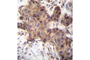 Immunohistochemistry analysis in formalin fixed and paraffin embedded human breast carcinoma reacted with GDF9 Antibody (N-term) followed by peroxidase conjugation of the secondary antibody and DAB staining. (GDF9 antibody  (N-Term))