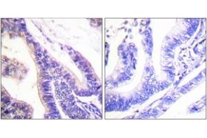 Immunohistochemistry analysis of paraffin-embedded human colon carcinoma tissue, using p70 S6 Kinase (Ab-418) Antibody. (RPS6KB1 antibody  (AA 384-433))