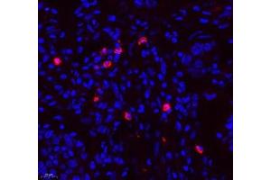 Immunofluorescence of paraffin embedded human lung cancer using TEAD3 (ABIN7075852) at dilution of 1: 700 (400x lens) (TEAD3 antibody)