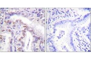 Immunohistochemistry analysis of paraffin-embedded human lung carcinoma, using SENP6 Antibody. (SENP6 antibody  (AA 1042-1091))