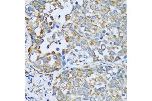 Immunohistochemistry of paraffin-embedded human lung cancer using RARS antibody. (RARS antibody)