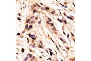 Formalin-fixed and paraffin-embedded human cancer tissue reacted with the primary antibody, which was peroxidase-conjugated to the secondary antibody, followed by AEC staining. (Retinoblastoma 1 antibody  (pSer608))