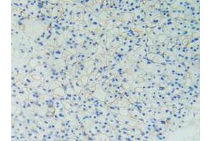 IHC-P analysis of Human Kidney Cancer Tissue, with DAB staining. (PODXL antibody  (AA 220-431))