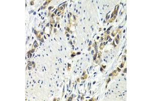 Immunohistochemistry of paraffin-embedded human stomach cancer using WNT3A antibody at dilution of 1:200 (400x lens).