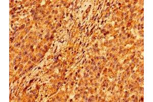 Immunohistochemistry of paraffin-embedded human colon cancer using ABIN7146306 at dilution of 1:100 (ORAI1 antibody  (AA 1-87))