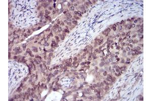 Immunohistochemical analysis of paraffin-embedded cervical cancer tissues using ERBB4 mouse mAb with DAB staining. (ERBB4 antibody  (AA 1159-1308))