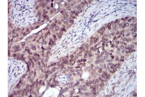 Immunohistochemical analysis of paraffin-embedded cervical cancer tissues using ERBB4 mouse mAb with DAB staining.