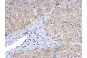 IHC-P Image Immunohistochemical analysis of paraffin-embedded human hepatoma, using Creatine kinase (brain) antibody, antibody at 1:500 dilution. (CKB antibody)