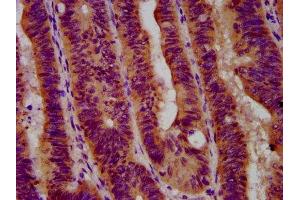 IHC image of ABIN7153944 diluted at 1:600 and staining in paraffin-embedded human colon cancer performed on a Leica BondTM system. (GBA antibody  (AA 215-343))