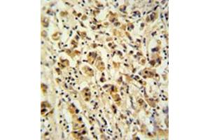Formalin fixed and paraffin embedded human breast carcinoma reacted with DDX49 Antibody (C-term) followed by peroxidase conjugation of the secondary antibody and DAB staining. (DDX49 antibody  (C-Term))
