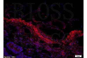 Formalin-fixed and paraffin embedded human colon cancer labeled with Anti Amphiregulin Polyclonal Antibody, Unconjugated followed by conjugation to the secondary antibody and DAPI staining