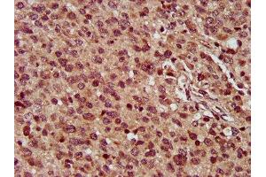 IHC image of ABIN7159657 diluted at 1:300 and staining in paraffin-embedded human glioma performed on a Leica BondTM system.