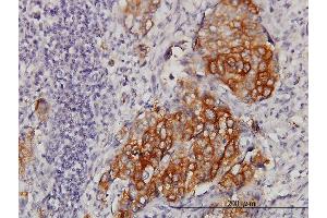 Immunoperoxidase of monoclonal antibody to EIF4G3 on formalin-fixed paraffin-embedded human lung, adenosquamous cell carcinoma. (EIF4G3 antibody  (AA 1-515))