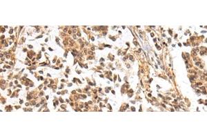 Immunohistochemistry of paraffin-embedded Human breast cancer tissue using NHLRC2 Polyclonal Antibody at dilution of 1:40(x200) (NHLRC2 antibody)