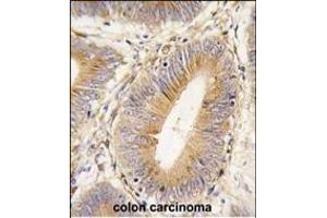 Formalin-fixed and paraffin-embedded human colon carcinoma tissue reacted with AKR1B1 antibody (Center) (ABIN389206 and ABIN2839364) , which was peroxidase-conjugated to the secondary antibody, followed by DAB staining. (AKR1B1 antibody  (AA 102-135))