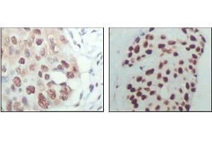 Immunohistochemical analysis of paraffin-embedded human esophagus cancer (left) and breast carcinoma tissue (right), showing nuclear localization with DAB staining using HDAC3 antibody.