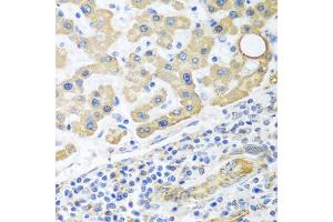 Immunohistochemistry of paraffin-embedded human liver cancer using GLUD1 antibody. (GLUD1 antibody)