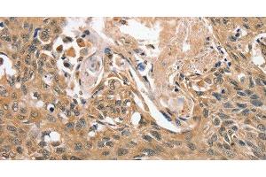 Immunohistochemistry of paraffin-embedded Human esophagus cancer tissue using RBM38 Polyclonal Antibody at dilution 1:45 (RBM38 antibody)