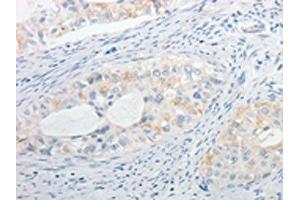 The image on the left is immunohistochemistry of paraffin-embedded Human cervical cancer tissue using ABIN7130256(MPZ Antibody) at dilution 1/15, on the right is treated with fusion protein. (MPZ antibody)