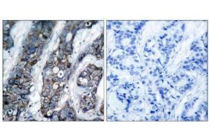 Immunohistochemical analysis of paraffin-embedded human breast carcinoma tissue using HER2 (phospho-Tyr1248) antibody (E011079). (ErbB2/Her2 antibody  (pTyr1248))