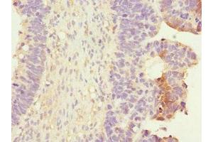 Immunohistochemistry of paraffin-embedded human ovarian cancer using ABIN7167394 at dilution of 1:100 (RALB antibody  (AA 1-206))