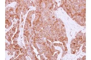 IHC-P Image Immunohistochemical analysis of paraffin-embedded human adenocarcinoma, using HPRT, antibody at 1:500 dilution.