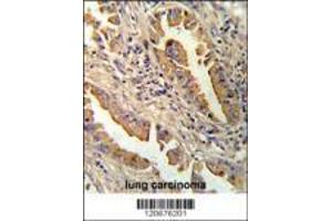 Formalin-fixed and paraffin-embedded human lung carcinoma reacated with IL8 antibody which was peroxidase-conjugated to the secondary antibody, followed by DAB staining.