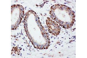 IHC-P: MTCO1 antibody testing of human breast cancer tissue