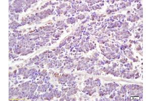 Formalin-fixed and paraffin embedded human lung carcinoma labeled with Anti phospho-STAT1 (Ser727) Polyclonal Antibody, Unconjugated (ABIN746168) at 1:200 followed by conjugation to the secondary antibody and DAB staining (STAT1 antibody  (pSer727))