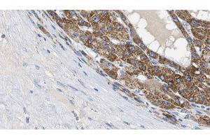 ABIN6269219 at 1/100 staining Human liver cancer tissue by IHC-P. (Cadherin 5 antibody  (C-Term))