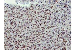 IHC-P Image Immunohistochemical analysis of paraffin-embedded HS578T xenograft, using CLP1, antibody at 1:100 dilution. (CLP1 antibody  (Center))
