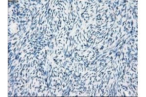 Immunohistochemical staining of paraffin-embedded Adenocarcinoma of breast tissue using anti-FOSL1 mouse monoclonal antibody.