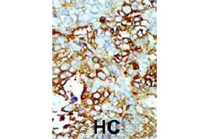 Formalin-fixed and paraffin-embedded human hepatocellular carcinoma tissue reacted with MAP4K2 polyclonal antibody  , which was peroxidase-conjugated to the secondary antibody, followed by AEC staining . (MAP4K2 antibody  (Internal Region))