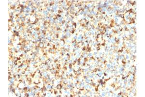 Formalin-fixed, paraffin-embedded human Melanoma stained with CD63-Monospecific Recombinant Mouse Monoclonal Antibody (rMX-49. (Recombinant CD63 antibody)