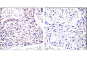 Immunohistochemistry analysis of paraffin-embedded human breast carcinoma, using IRS-1 (Phospho-Ser323) Antibody. (IRS1 antibody  (pSer323))