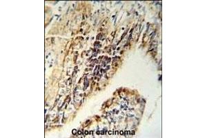 Immunohistochemistry (Paraffin-embedded Sections) (IHC (p)) image for anti-Checkpoint Kinase 2 (CHEK2) (AA 111-141), (N-Term) antibody (ABIN1881196)