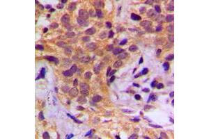 Immunohistochemical analysis of HSP90 beta (pS254) staining in human breast cancer formalin fixed paraffin embedded tissue section.