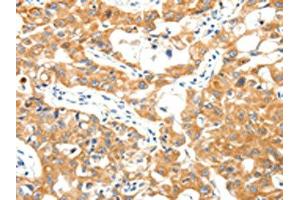 The image on the left is immunohistochemistry of paraffin-embedded Human lung cancer tissue using ABIN7192878(TRAF3 Antibody) at dilution 1/40, on the right is treated with synthetic peptide. (TRAF3 antibody)