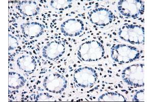 Immunohistochemical staining of paraffin-embedded Adenocarcinoma of ovary tissue using anti-CHEK2mouse monoclonal antibody. (CHEK2 antibody)